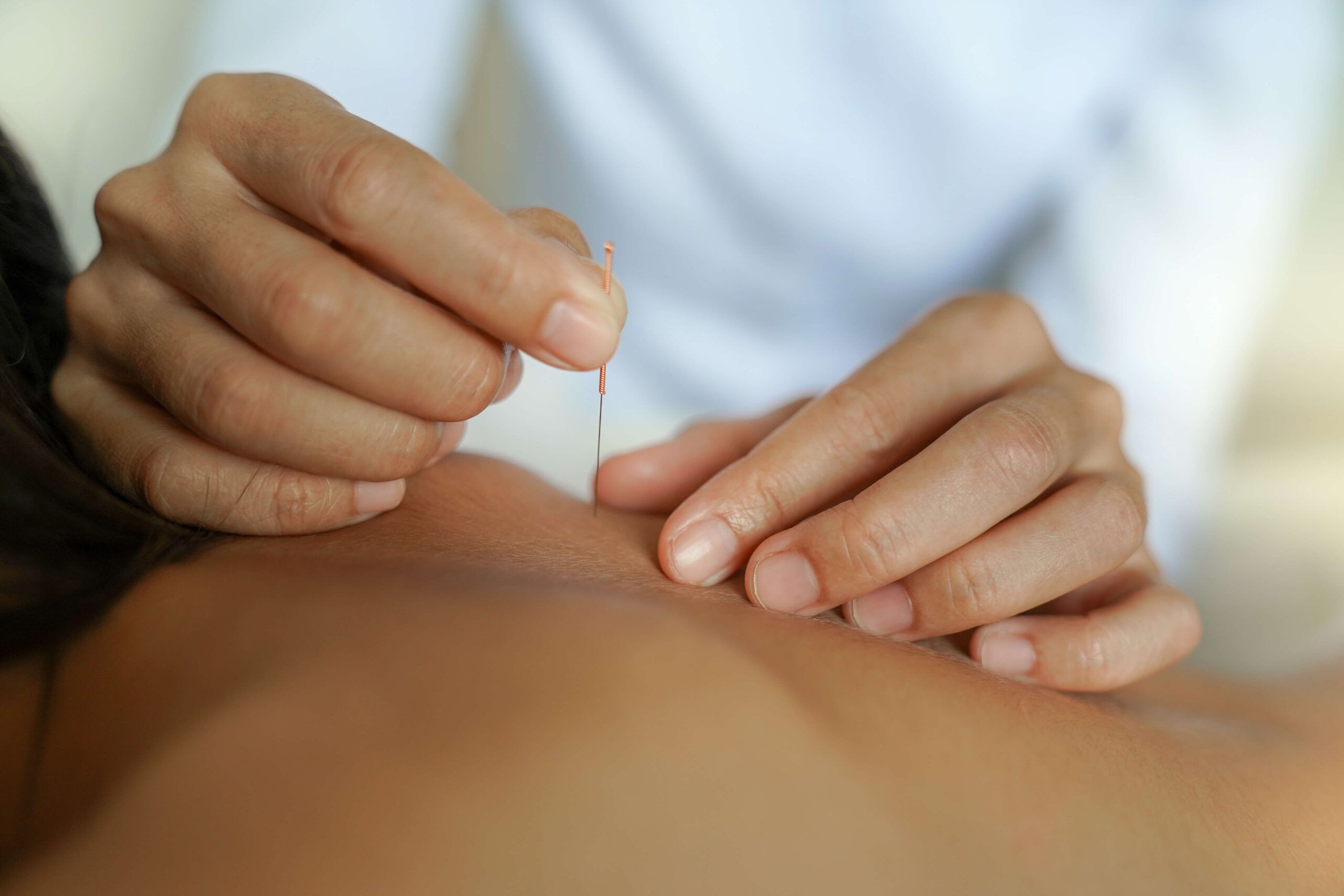 dry-needling